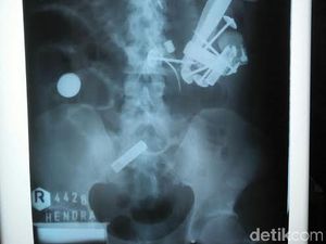 Pengakuan Hendro dan Tanda Tanya soal Pisau dan Paku di Perutnya Pengakuan Hendro dan Tanda Tanya soal Pisau dan Paku di Perutnya