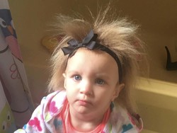 Idap Kondisi Unik, Rambut Bocah Ini Selalu Jabrik dan Tak Bisa Disisir