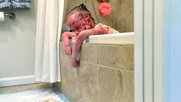 Potret Para Penyandang Kondisi Kulit Serapuh Sayap Kupu-kupu