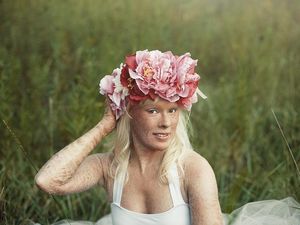 Inspiratif, Wanita dengan Tubuh Bersisik Terpilih Jadi Ratu Kecantikan