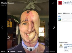 Kisah Pria Tampan dengan Separuh Wajah Hilang Digerogoti Tumor