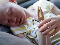 Anak-anak Hantu Asal Tanzania, Dimutilasi karena Albino