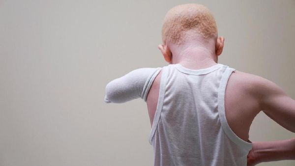 Potret Anak-anak Hantu Albino Asal Tanzania Korban Mutilasi