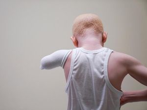 Potret Anak-anak Hantu Albino Asal Tanzania Korban Mutilasi