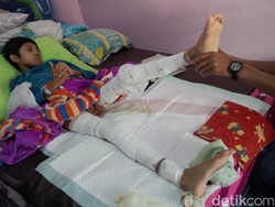 Bocah Helmi 5 Bulan Menahan Sakit Luka Bakar karena Tersambar Api Unggun