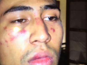 Ini Foto Babak Belur Anak Jeremy Thomas Usai Dikeroyok Oknum Polisi