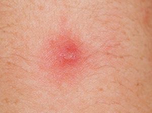 Tentang Benjolan di Ketiak, Kenali dari Awal!