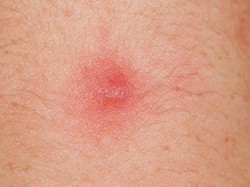 Tentang Benjolan di Ketiak, Kenali dari Awal!