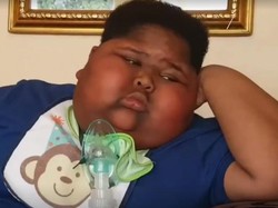 Idap Kelainan Langka, Bocah Ini Tak Bisa Berhenti Makan