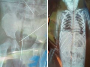 Bayi Ini Meninggal karena Infeksi, 7 Jarum Santet Bersarang di Tubuhnya Bayi Ini Meninggal karena Infeksi, 7 Jarum Santet Bersarang di Tubuhnya