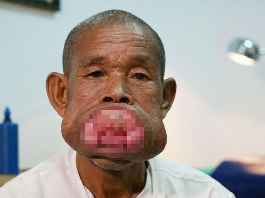 Mulut Pria Ini Penuh Tertutup Tumor, Begini Kondisinya Pasca Operasi