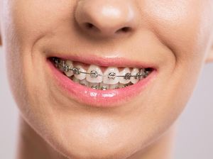 Dokter Ungkap Risiko Pasang Behel di Tukang Gigi Dokter Ungkap Risiko Pasang Behel di Tukang Gigi