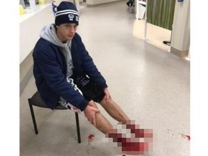 Diduga Diserang Kutu Laut, Kaki Remaja Australia Ini Penuh Luka Diduga Diserang Kutu Laut, Kaki Remaja Australia Ini Penuh Luka