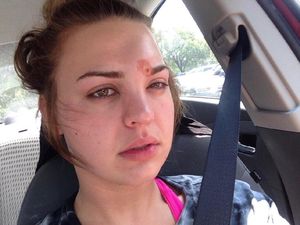 Sembarangan Pencet Jerawat, Wanita Ini Kena Infeksi Berbahaya