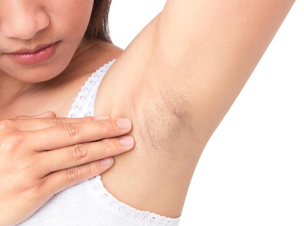 Benjolan di Vagina dan Ketiak, Masalah Apa? Benjolan di Vagina dan Ketiak, Masalah Apa?