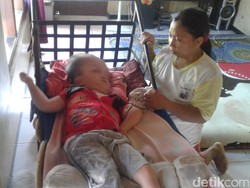 Pasca Operasi, Pengidap Hydrocephalus Ini Butuh Bantuan