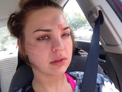 Kisah Horor Wanita yang Hampir Buta Gara-gara Pencet Jerawat