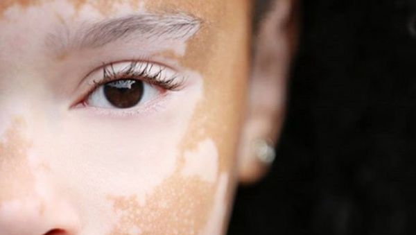 Foto Para Wanita Cantik dengan Kondisi Kulit Vitiligo
