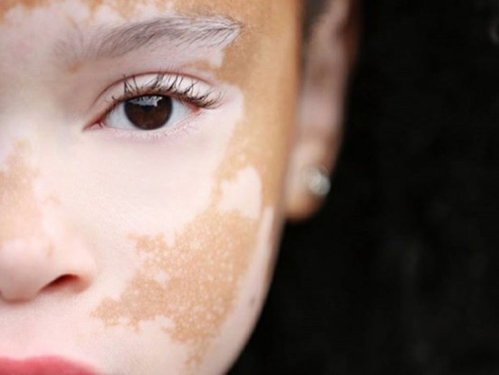 Foto Para Wanita Cantik dengan Kondisi Kulit Vitiligo