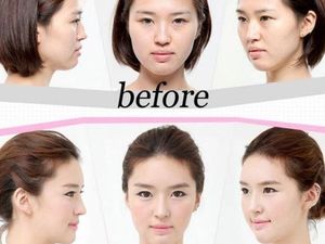 Selain Wisata, Orang Indonesia Suka Operasi Plastik ke Korea Selatan