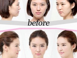 Selain Wisata, Orang Indonesia Suka Operasi Plastik ke Korea Selatan