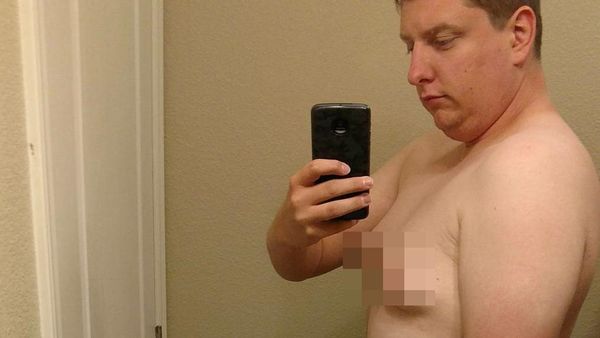 Foto: Gynaecomastia, Ketika Payudara Pria Tumbuh Seperti Wanita