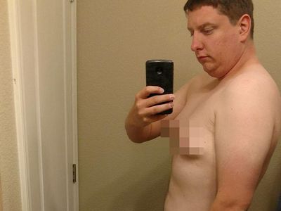 Foto: Gynaecomastia, Ketika Payudara Pria Tumbuh Seperti Wanita