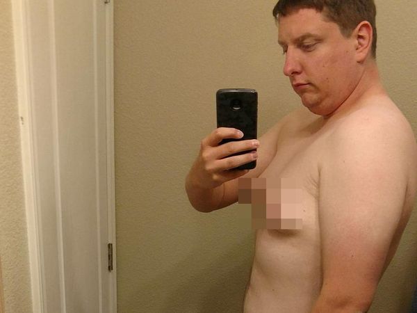 Foto: Gynaecomastia, Ketika Payudara Pria Tumbuh Seperti Wanita
