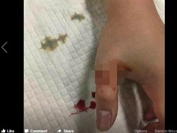 Hii! Jempol Orang Ini Menghitam Lalu Mati Setelah Digigit Ular