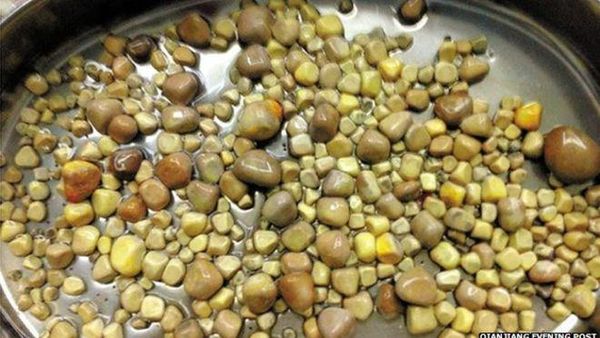 Foto: Kasus-kasus Unik Batu Ginjal: Ada yang Ribuan Hingga Sebesar Kelapa