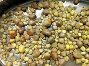 Foto: Kasus-kasus Unik Batu Ginjal: Ada yang Ribuan Hingga Sebesar Kelapa