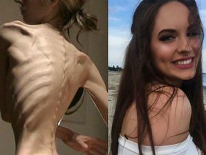 Foto Transformasi Para Wanita Anoreksia: Dari Kurus Kering Kembali Berisi