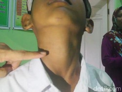 Kata Ahli Undip Soal Pestisida Penyebab Endemis Gondok di Brebes