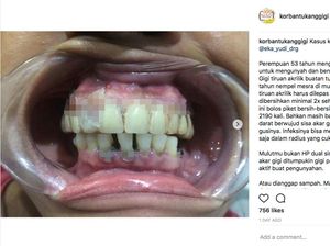 Jorok! Gigi Tiruan Ini 3 Tahun Tak Pernah Dilepas Pemiliknya