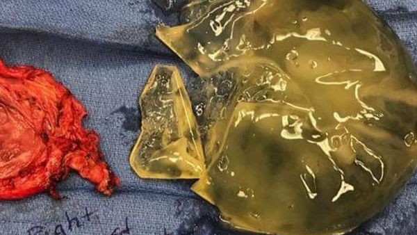 Foto: Mengerikannya Ketika Implan Payudara Gagal