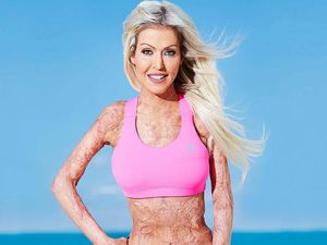 Ini Dana, Korban Pembakaran Hidup-hidup yang Kini Jadi Motivator