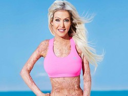 Ini Dana, Korban Pembakaran Hidup-hidup yang Kini Jadi Motivator