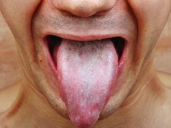 Kanker Mulut: Gejala, Penyebab, dan Pengobatannya