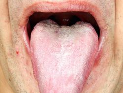 Sariawan di Samping Lidah, Bagaimana Mengobatinya?