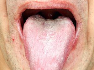 Sariawan di Samping Lidah, Bagaimana Mengobatinya?