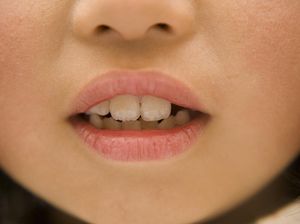 Kenapa Sariawan dan Sakit Tenggorokan Rentan Terjadi di Bulan Puasa?