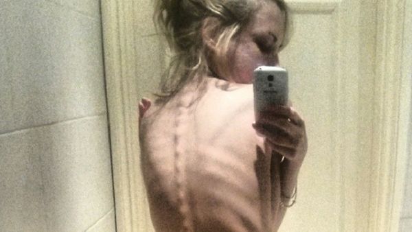 Tinggal Kulit dan Tulang, Potret Mereka yang Berjuang Lawan Anoreksia