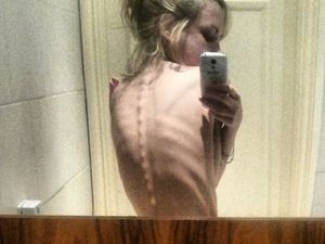 Tinggal Kulit dan Tulang, Potret Mereka yang Berjuang Lawan Anoreksia