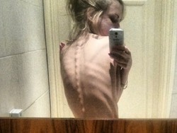 Dipicu Tren Pamer Tulang di Instagram, Gangguan Pola Makan Makin Mengancam