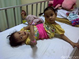 Miliki Kaki Tambahan, Balita Kembar Siam Asal Garut Dirawat di RSHS