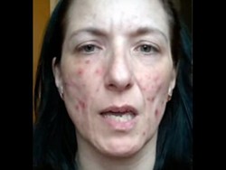 Idap Dermatillomania, Wanita Ini Selalu Ingin Menguliti Kulitnya