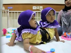 Penjelasan RSHS soal Kembar Siam Asal Garut tak Bisa Dipisah
