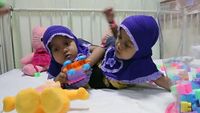 Kaki Tambahan Balita Kembar Siam Asal Garut Segera Dioperasi