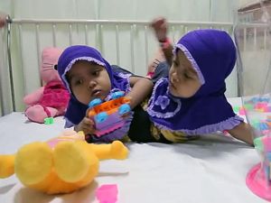 Besok RSHS Rencanakan Operasi Kaki Balita Kembar Siam Asal Garut