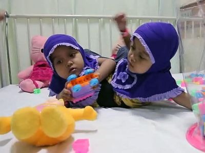 Kaki Tambahan Balita Kembar Siam Asal Garut Segera Dioperasi